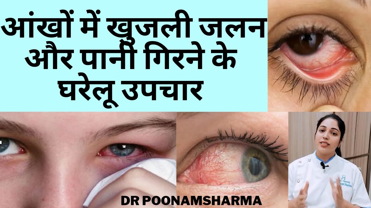 आँखों में जलन और खुजली के घरेलू उपचार | Home Remedies For Burning And Itching In The Eyes