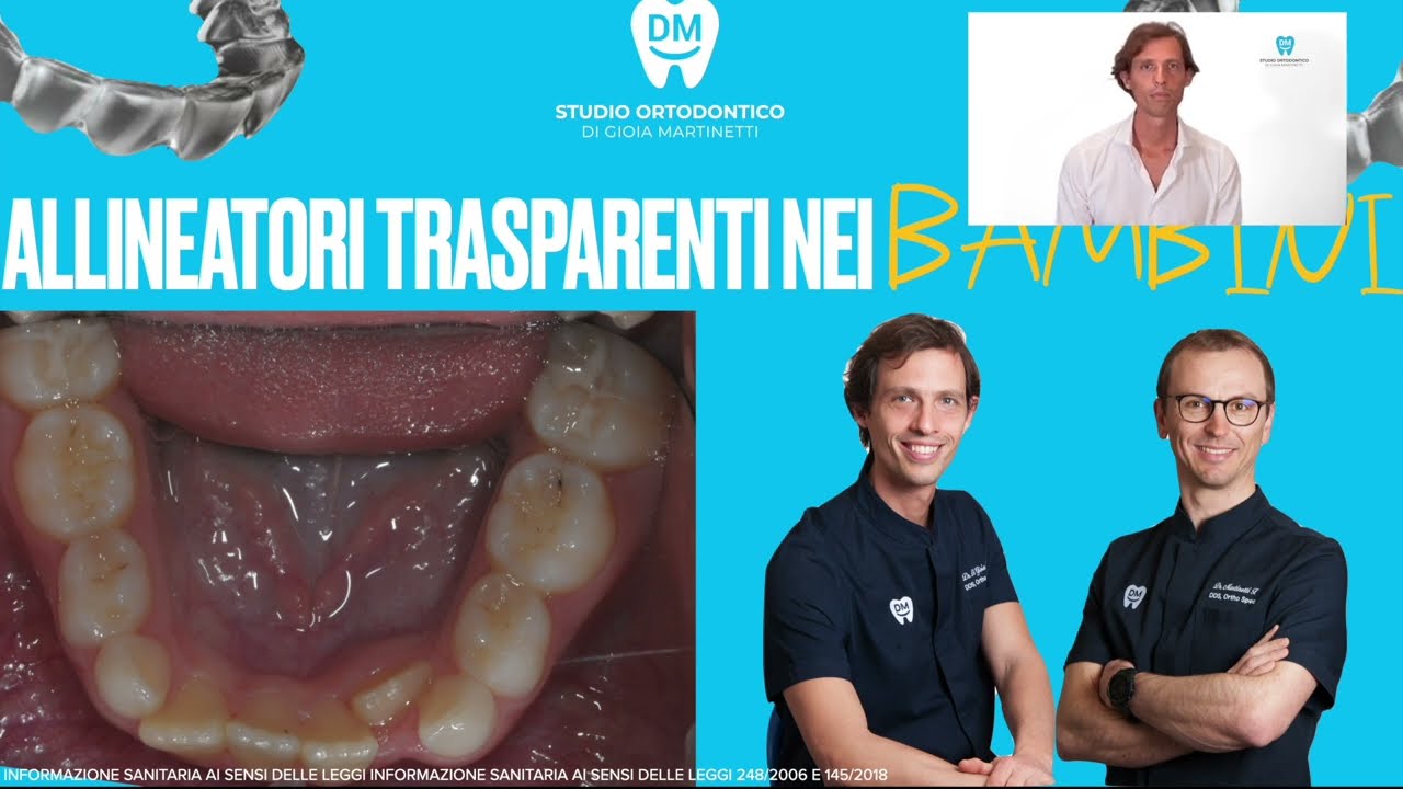 Denti storti disallineati nei bambini, apparecchio e denti latte incisivo indietro verso la lingua