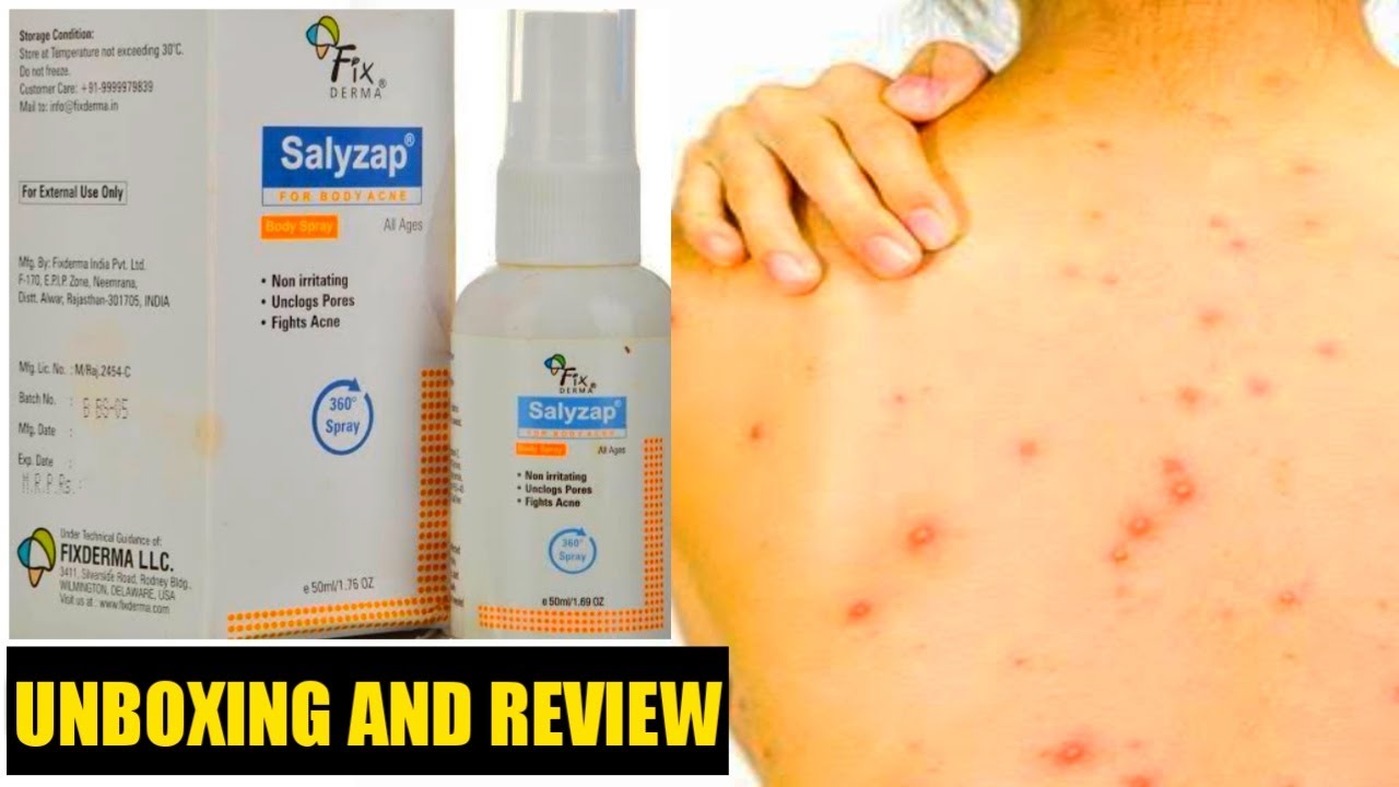 SALYZAP SPRAY | SALYZAP BODY SPRAY REVIEW | SALYZAP BODY SPRAY FOR BODY ACNE | HEENA