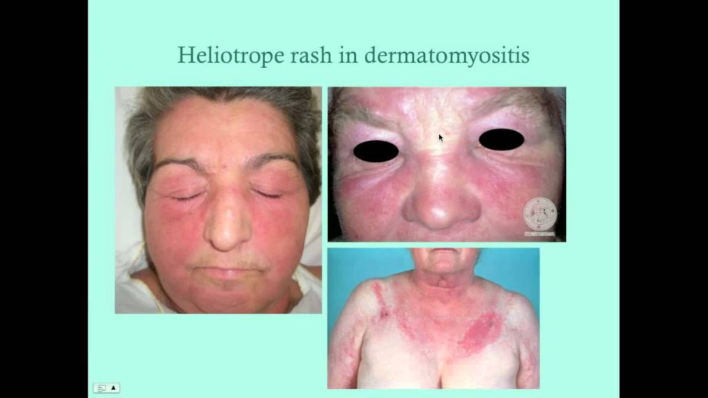 Myositis - CRASH! Medical Review Series