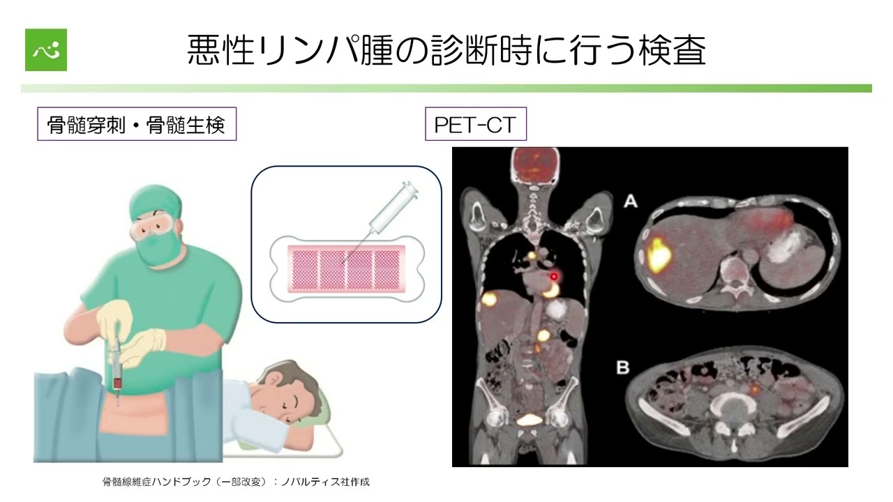悪性リンパ腫の診断と最新治療（血液・幹細胞移植科部長　池田宇次）【静岡がんセンター公開講座2025】