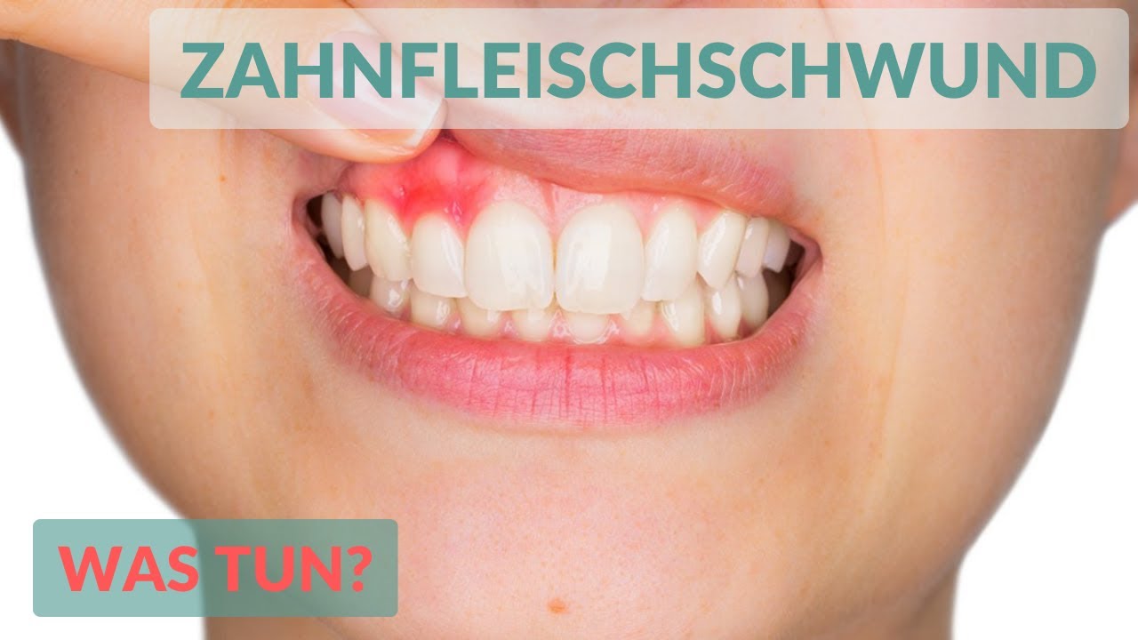 GINGIVITIS & PARODONTITIS | Erkennen einer Zahnfleischerkrankung und Prophylaxe