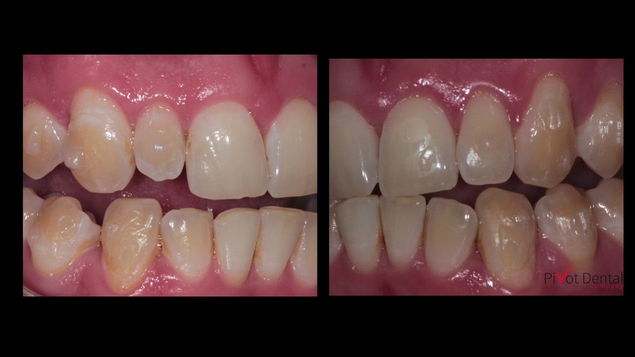 Боковые брекеты Invisalign не смещаются.