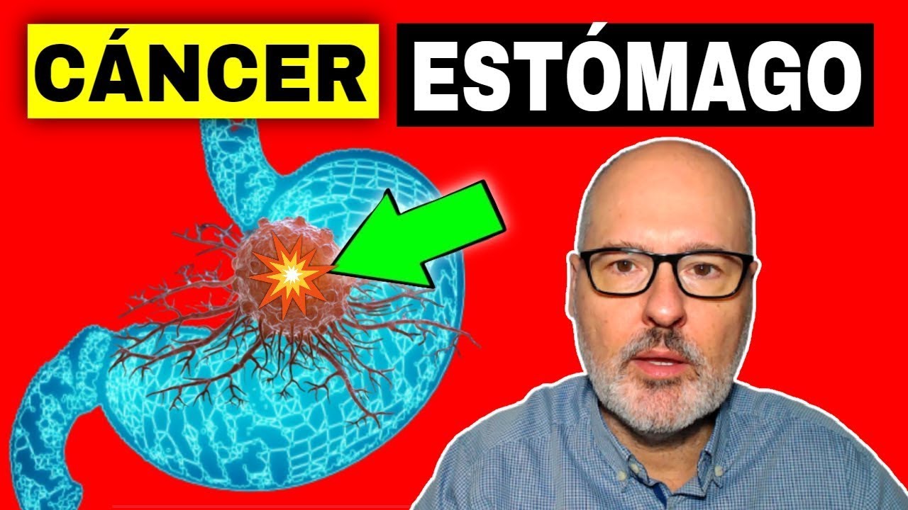SÍNTOMAS PELIGROSOS DE CÁNCER ESTÓMAGO (GÁSTRICO) 💥 Causas, Prevención y Tratamiento