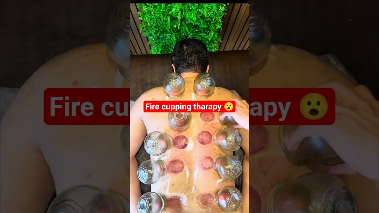 ASMR] Cupping Therapy with super Cups #asmr #cuppingtherapy#youtubeshorts#massage