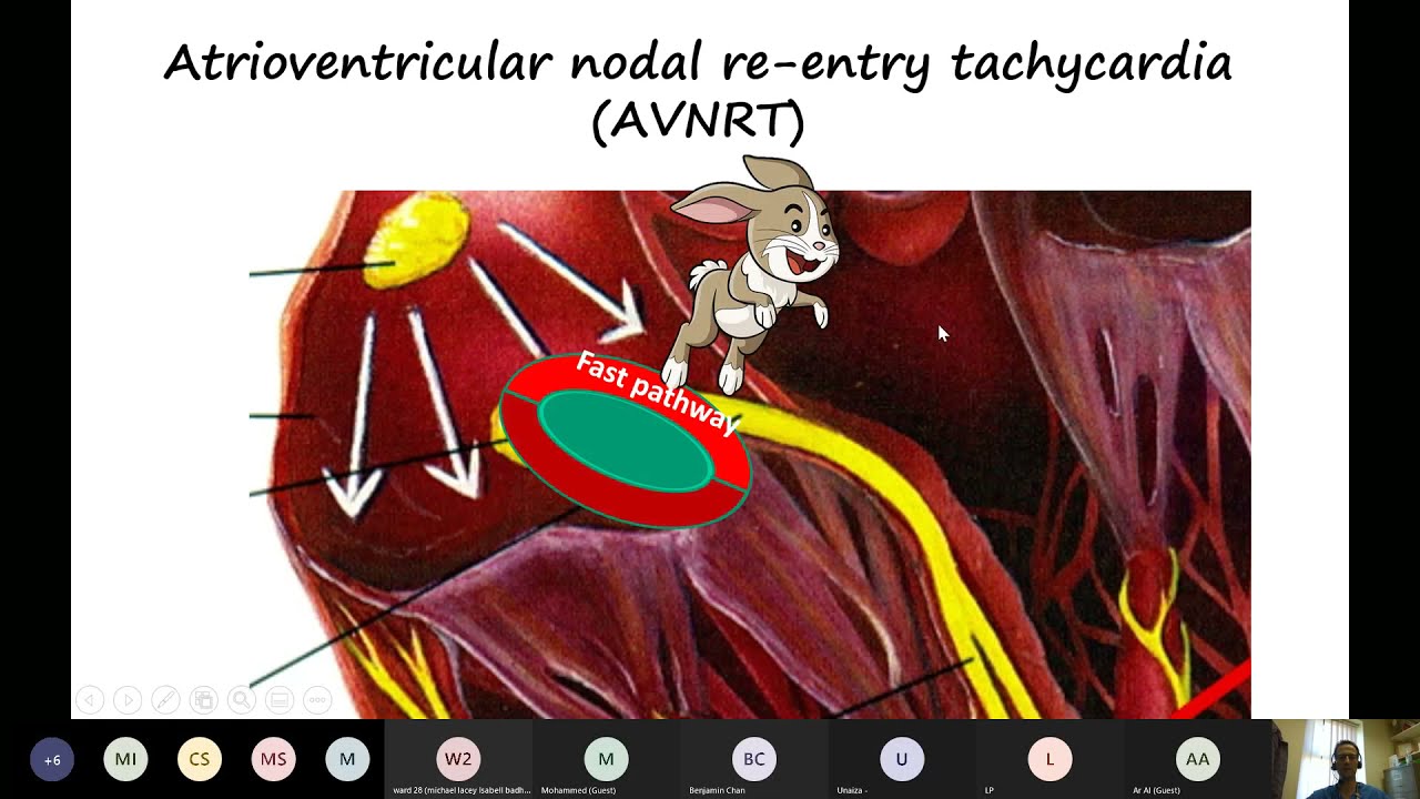 ECG interpretation: Tachyarrhythmias
