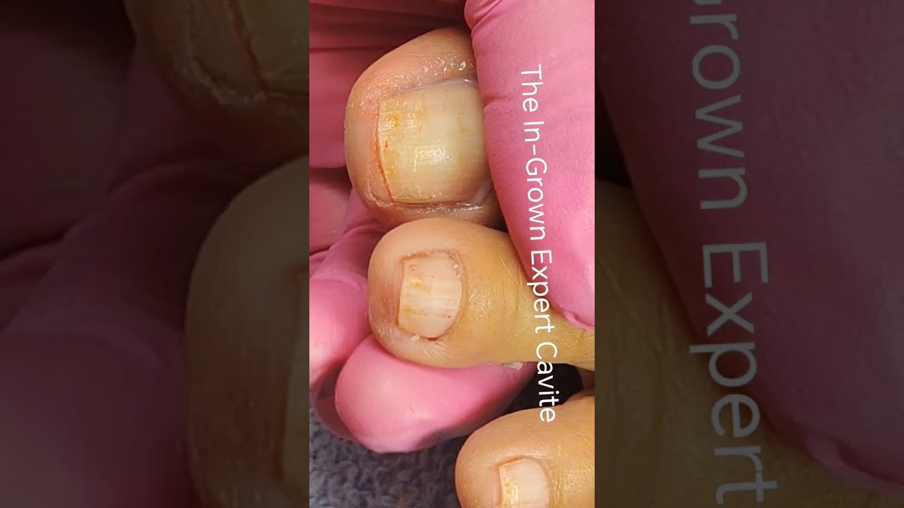 Full video pedicure and dryskin removal