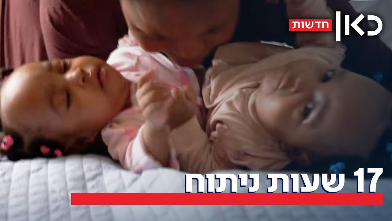הופרדו (לא) בלידתן: תאומות סיאמיות הופרדו בהצלחה