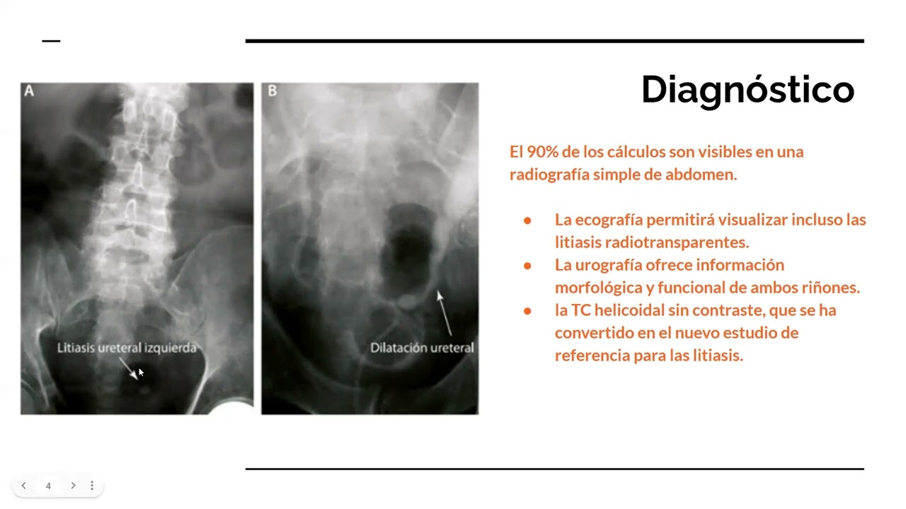 LITIASIS RENAL