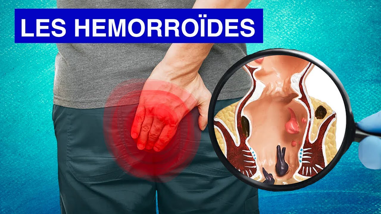 LES HEMORRO&Iuml;DES : Sympt&ocirc;mes, diagnostic et traitements