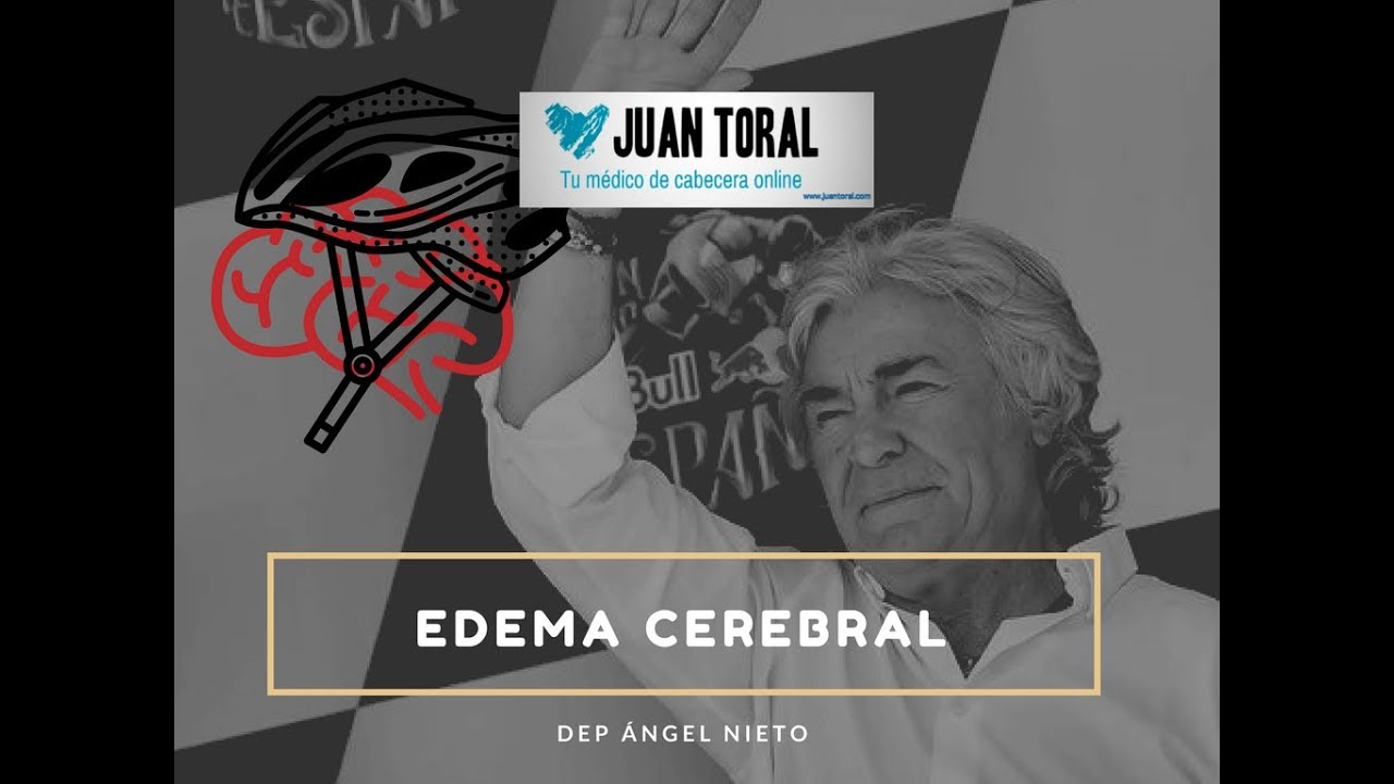 Que es el edema cerebral, la causa de la muerte de Angel Nieto