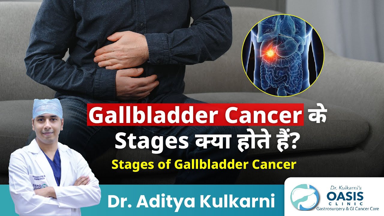 Gallbladder Cancer के Stages क्या होते हैं? Gallbladder Cancer Stages in Hindi | Dr Aditya Kulkarni