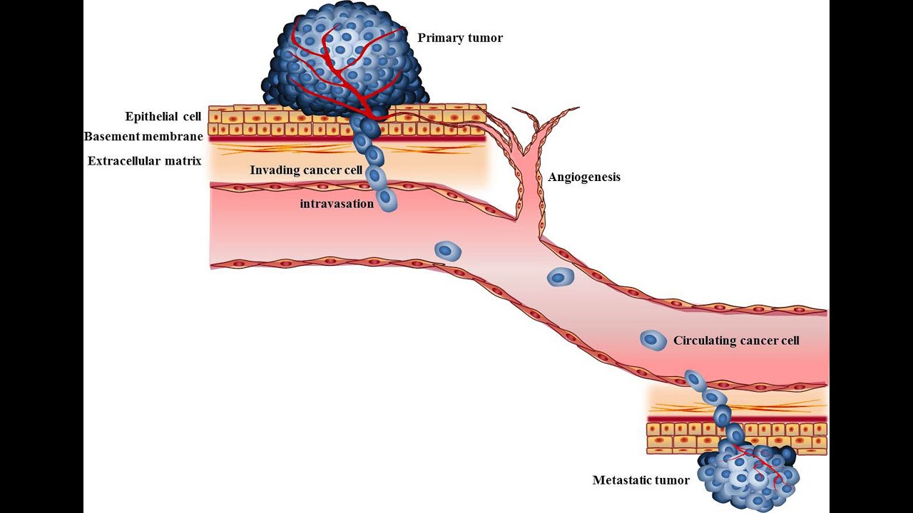 Biology of Tumor Metastasis ; Haematogenous spread, Lymphogenous spread, Across Body cavities