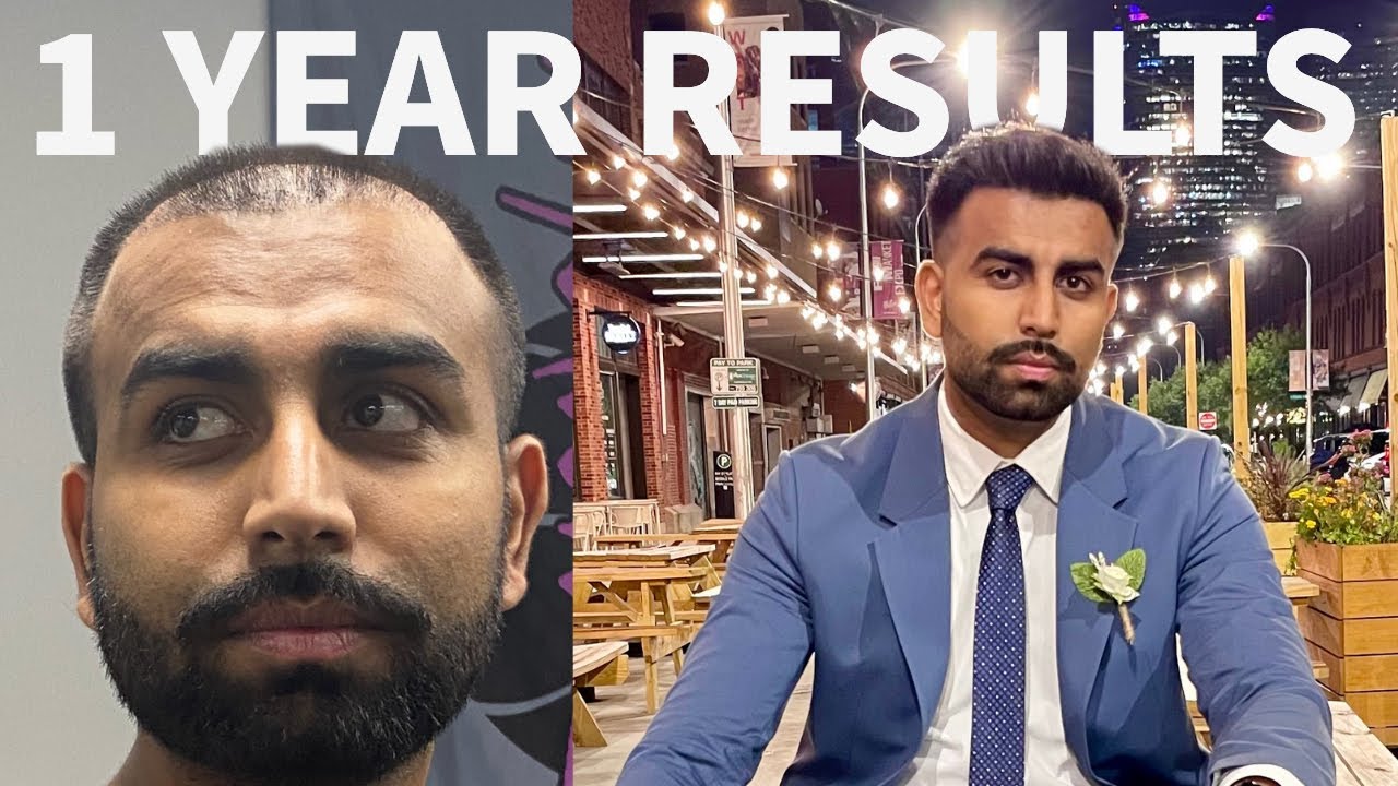 My 1 Year Turkey Hair Transplant Results | Full Recap Start to Finish!