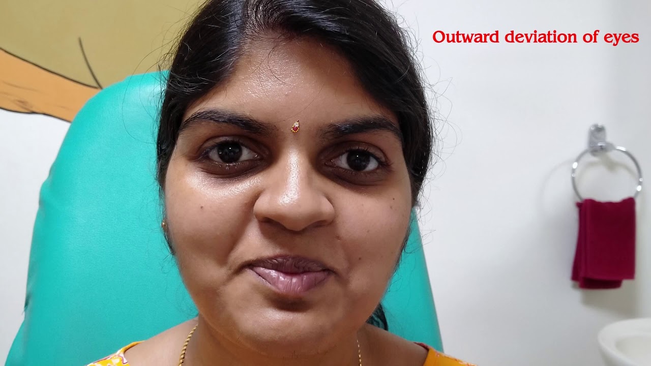 Dr. Remya Edachery_Case of Pseudostrabismus