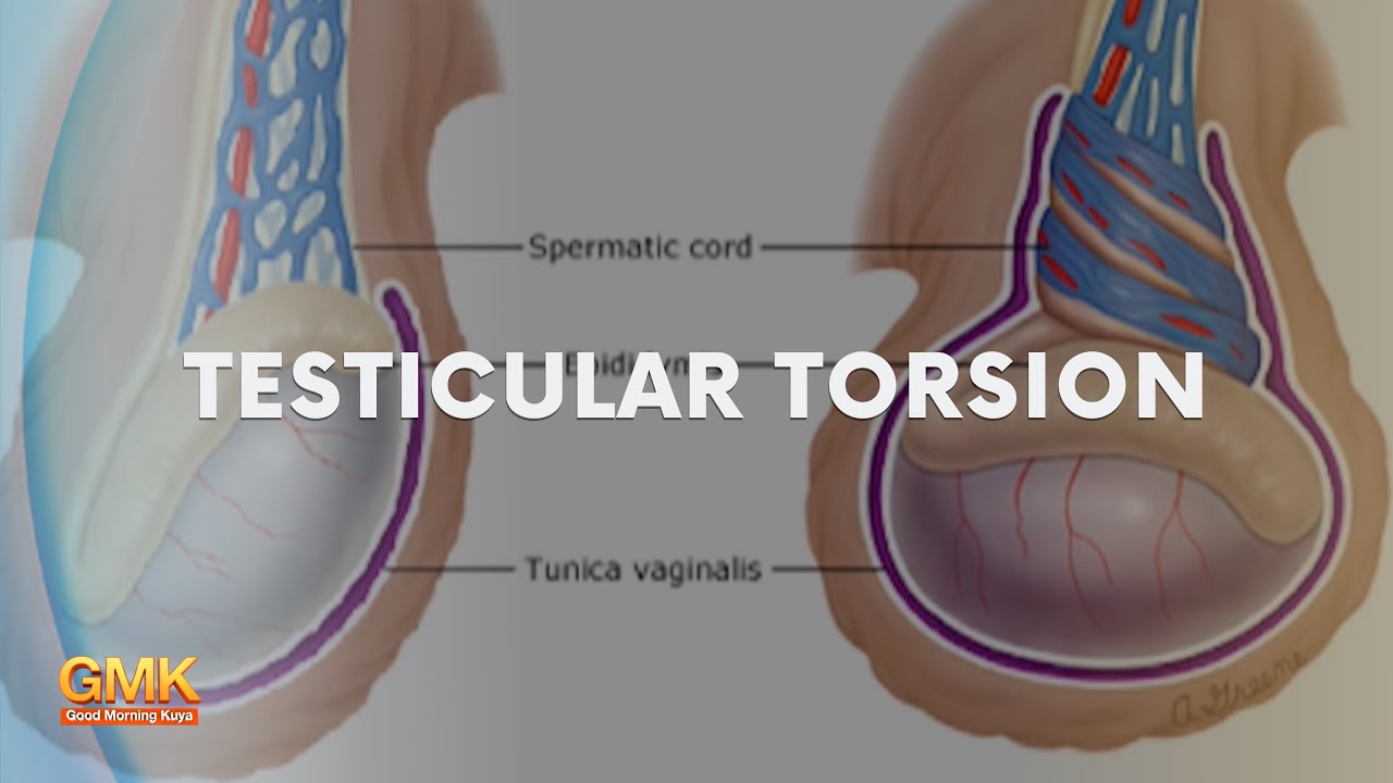 Testicular Torsion (Part 1) | Usapang Pangkalusugan