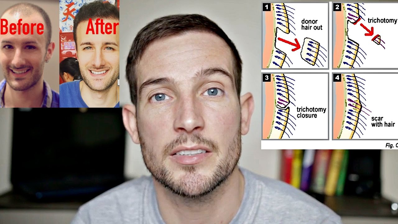 How Stu Got His Hair Back - Hair Loss Gone Good