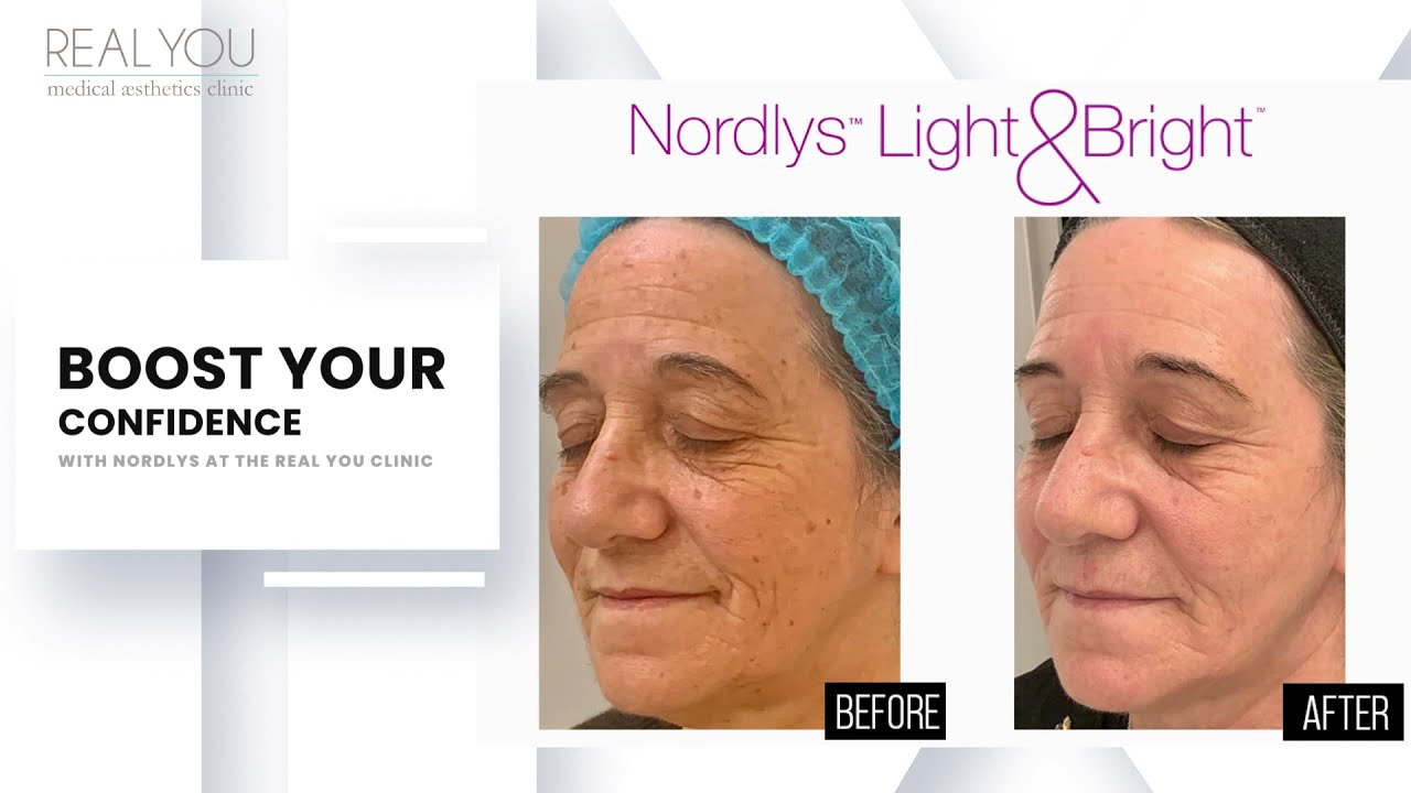 Ground-breaking Nordlys Treatments at Real You Clinic now with Light & Bright multi-treatment