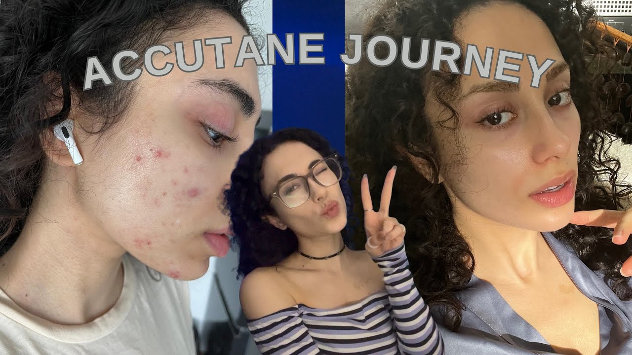My 6 Months Isotretinoin Journey | What Products To Use? What To Watch Out For?