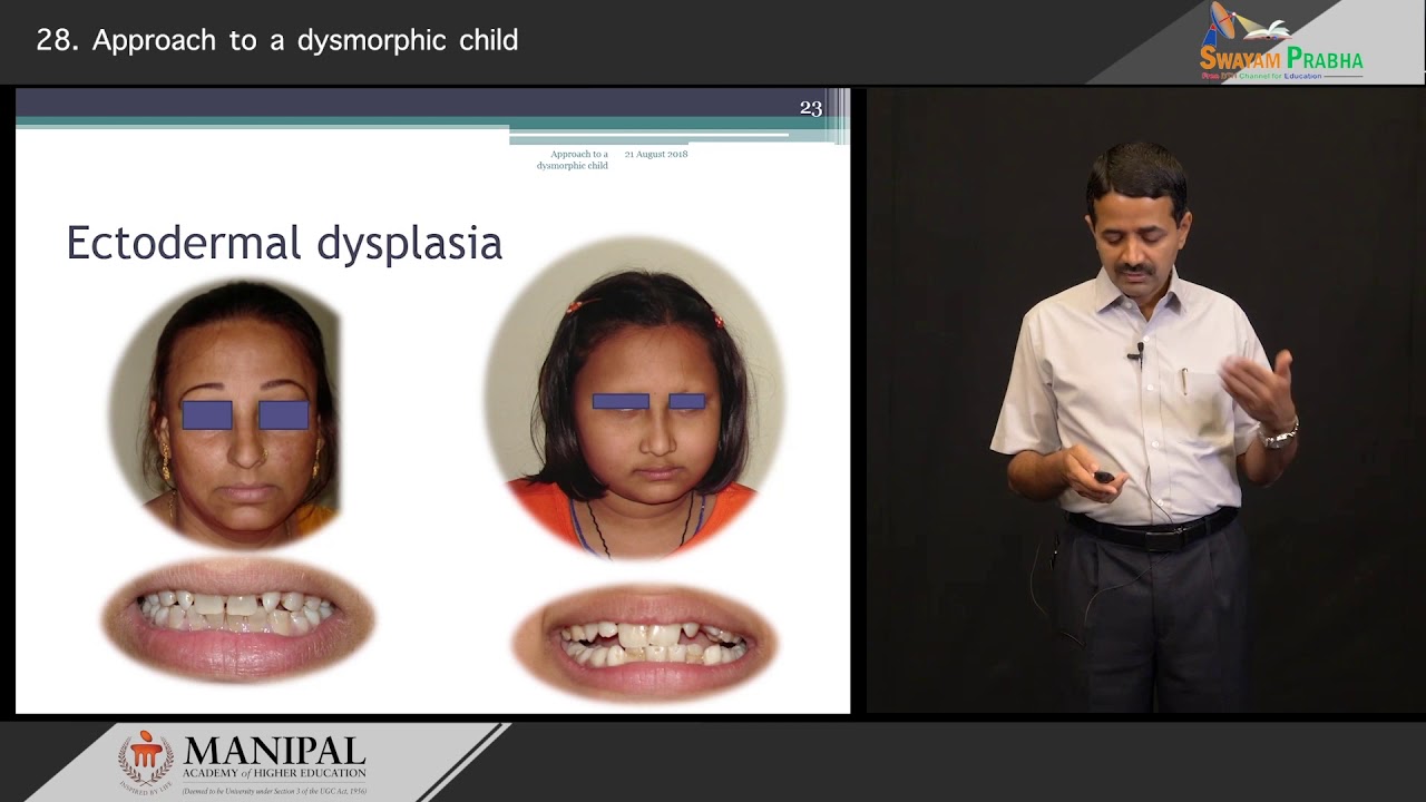 Approach to a dysmorphic child