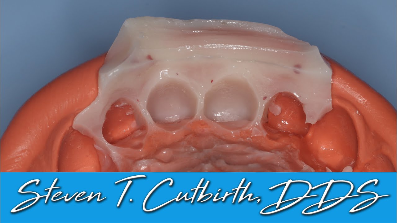 Temporary Veneer Fabrication - Dental Minute with Steven T. Cutbirth, DDS