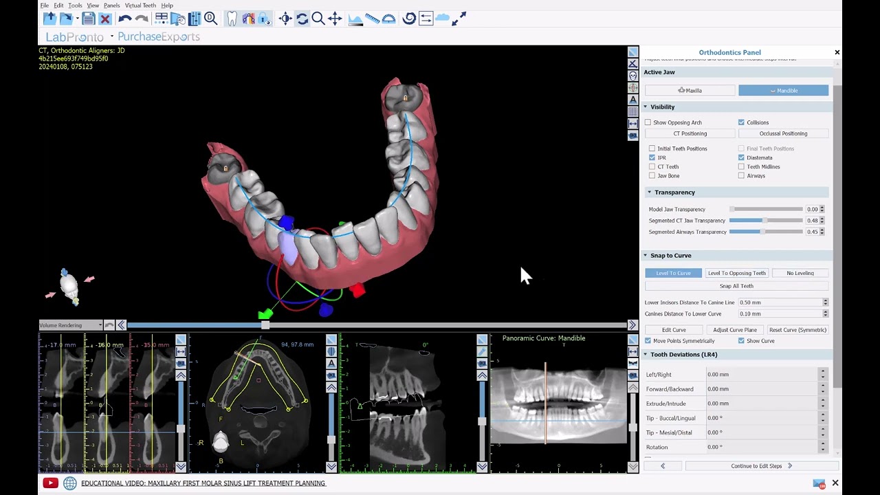 BSP V4.13: Aligner Digital Tooth Setup and Teeth Movement Controls with True Anatomical Movement