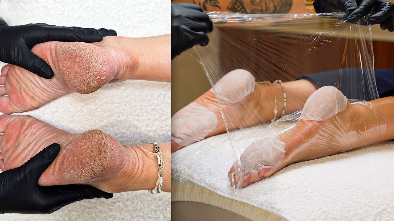 The Most Satisfying Dry Cracked Heel Transformation