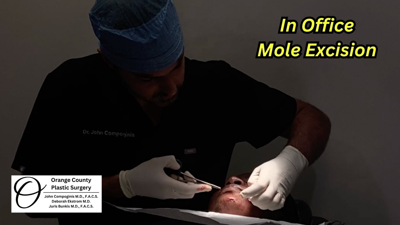 In Office Mole Excision | Orange County Plastic Surgery #plasticsurgeon #plasticsurgeryresults