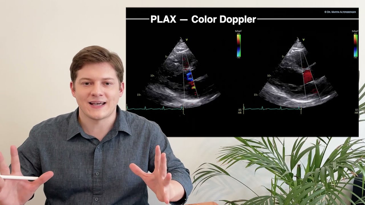 〖Echocardiography〗 Parasternal Long Axis View (PLAX) part 2
