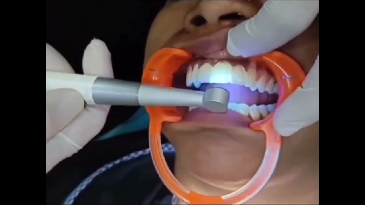 porcelain veneers cosmetic dentistry #citydentalhospital #korba (c.g)
