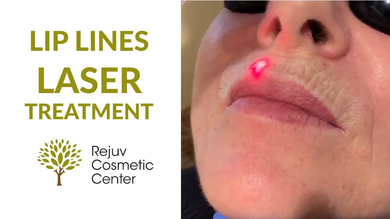 Lip Lines Sciton LaserTreatment- Rejuv Cosmetic Center NJ