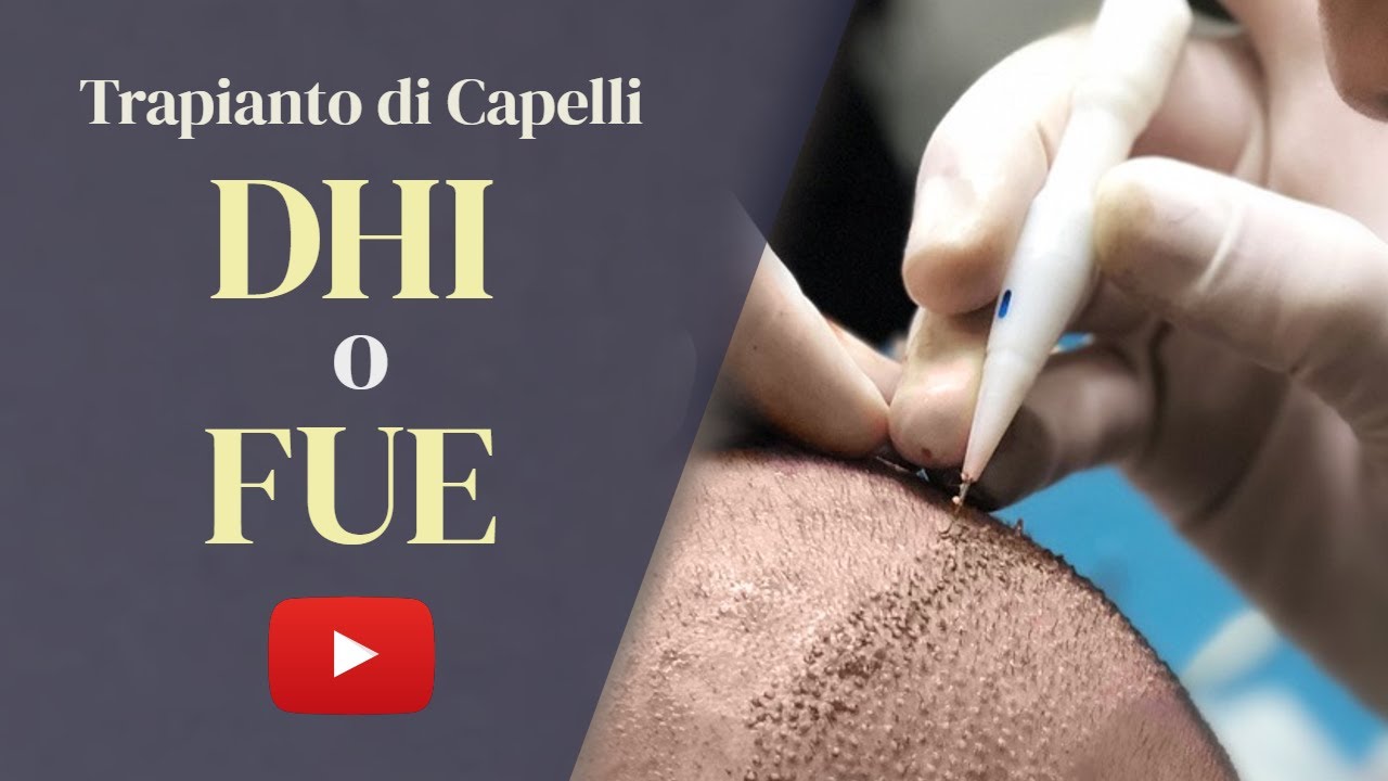 Trapianto di capelli FUE o DHI: Qual è la scelta migliore nel 2023?