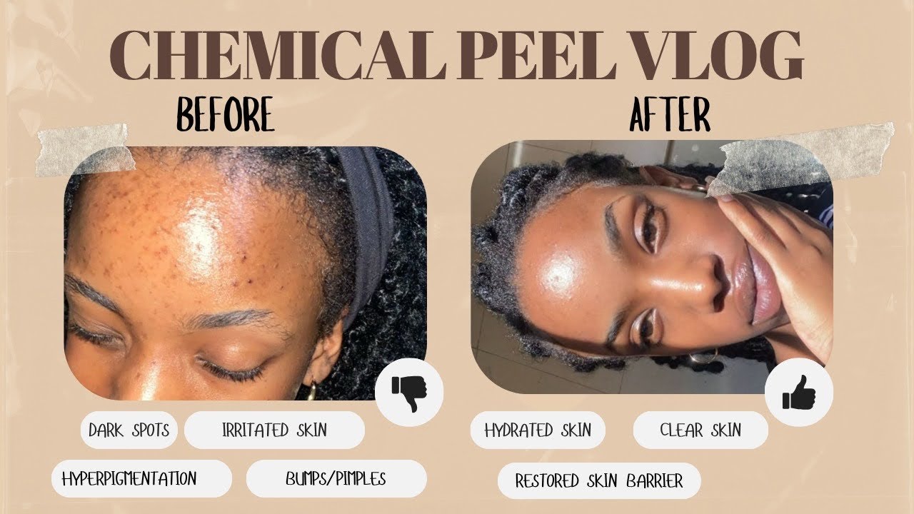 I Got a Chemical Peel!👀| My Honest Experience + Healing Journey ✨