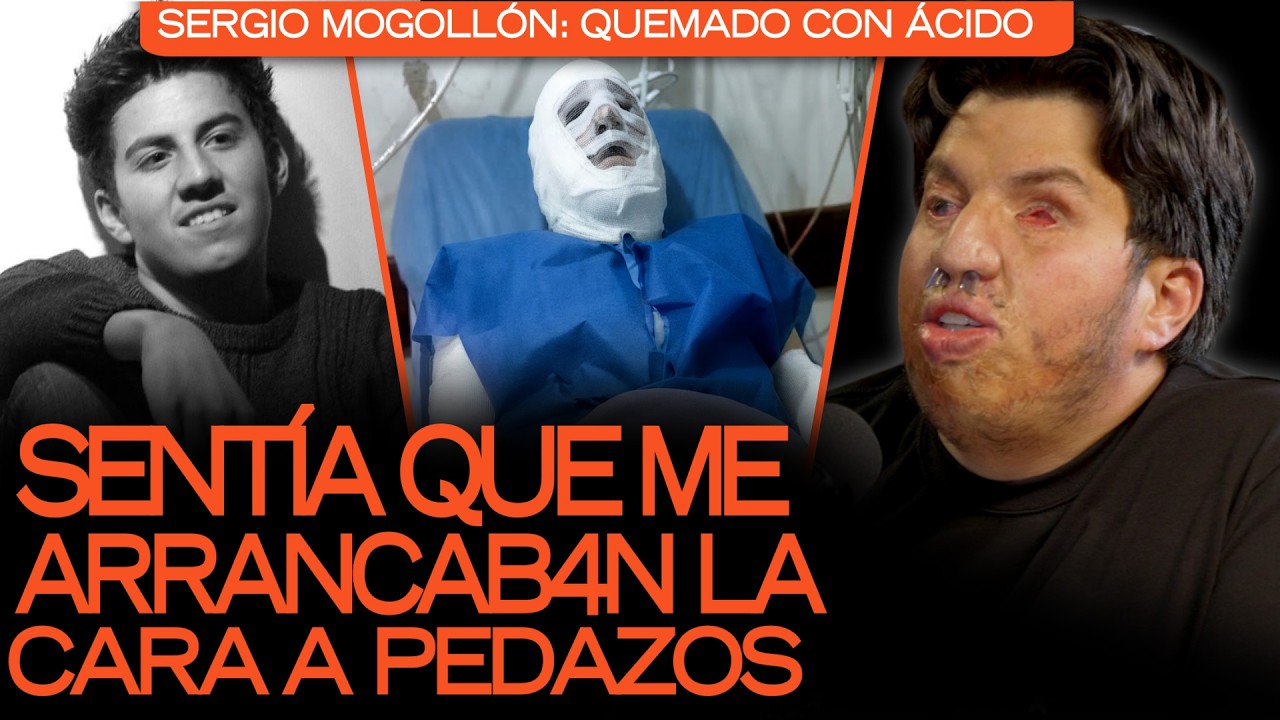 &iexcl;FUI ATACADO BRUT4LM3NTE CON &Aacute;CIDO Y TRAS M&Aacute;S DE 60 CIRUG&Iacute;AS, LOGR&Eacute; SOBREVIVIR: ESTUVE 5 A&Ntilde;OS CIEGO!