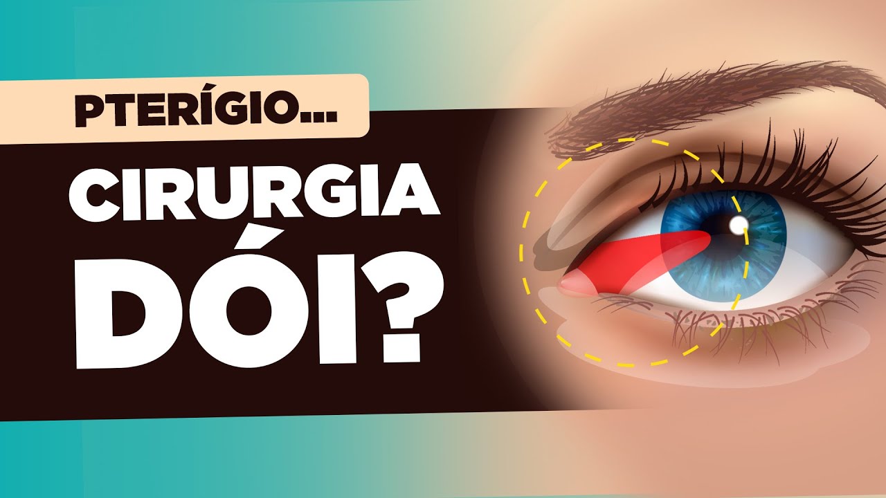 A Cirurgia De Pter&iacute;gio &Eacute; Dolorosa?
