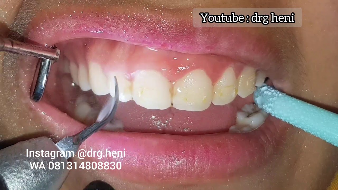Akhirnyaaa 👏👏👏 dilepas juga ... | lepas behel metal | pembersihan sisa2 lem gigi | drg heni