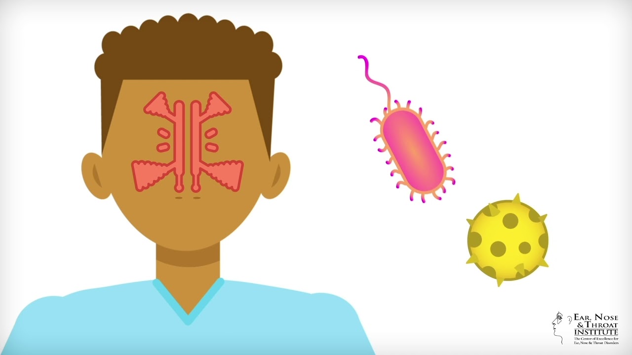 ENT Institute    What is sinusitis? preview