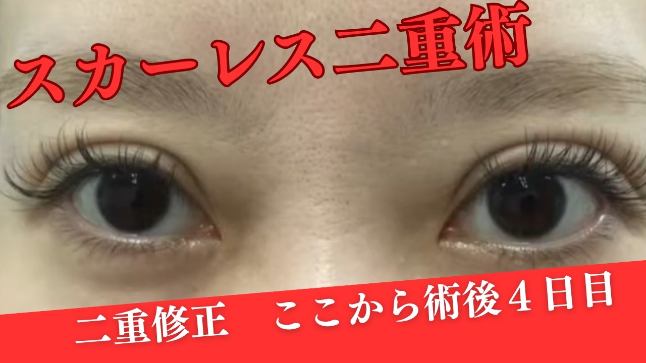 スカーレスで二重修正　４日目