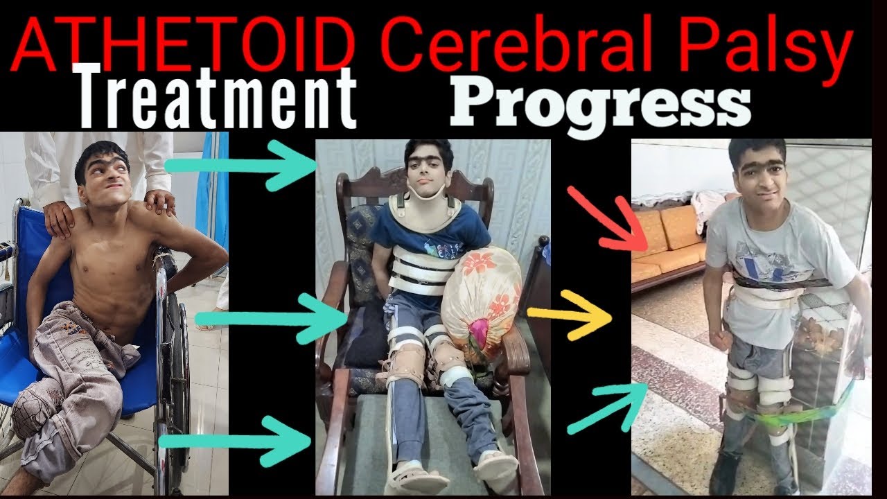 Athetoid Cerebral Palsy/ During treatment progress / Adult Cerebral Palsy Patient