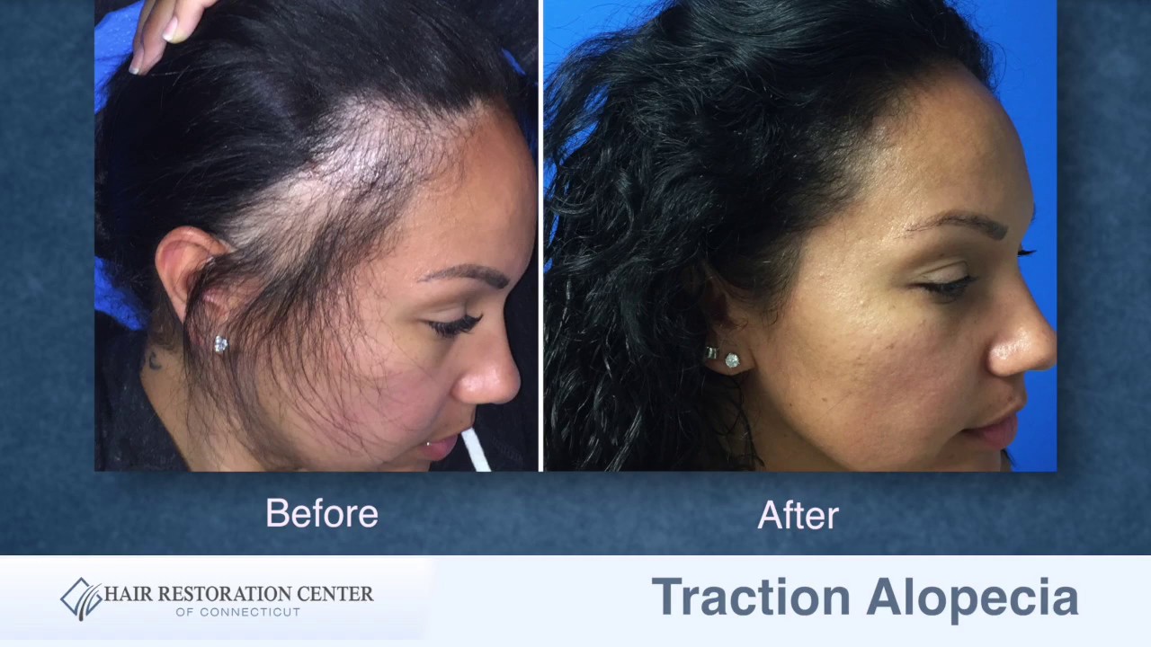Traction Alopecia Case Study by Scott Boden, MD, Hartford, Connecticut