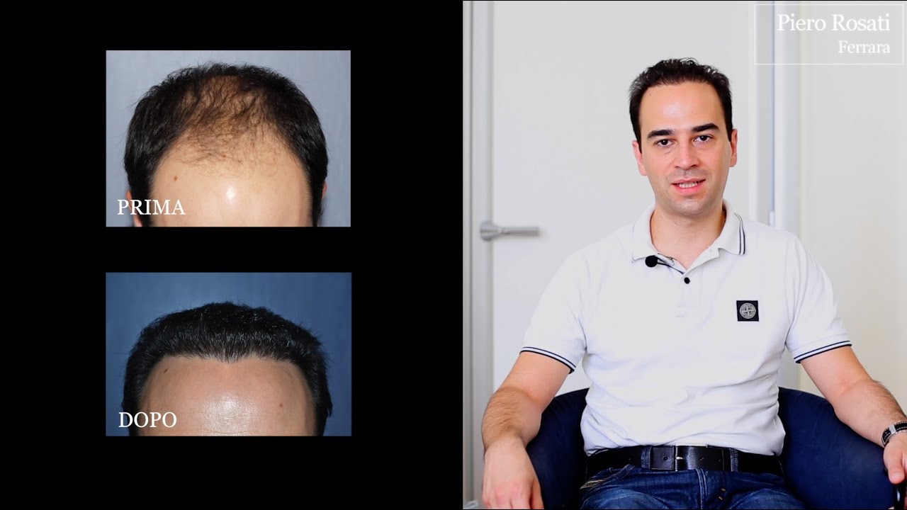 Risultati trapianto di capelli: la testimonianza di Federico