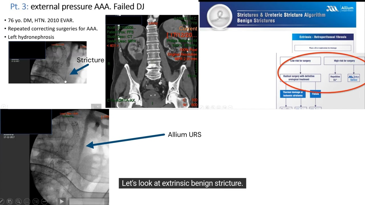 Allium Treatment Algorithms  URS & BUS 2