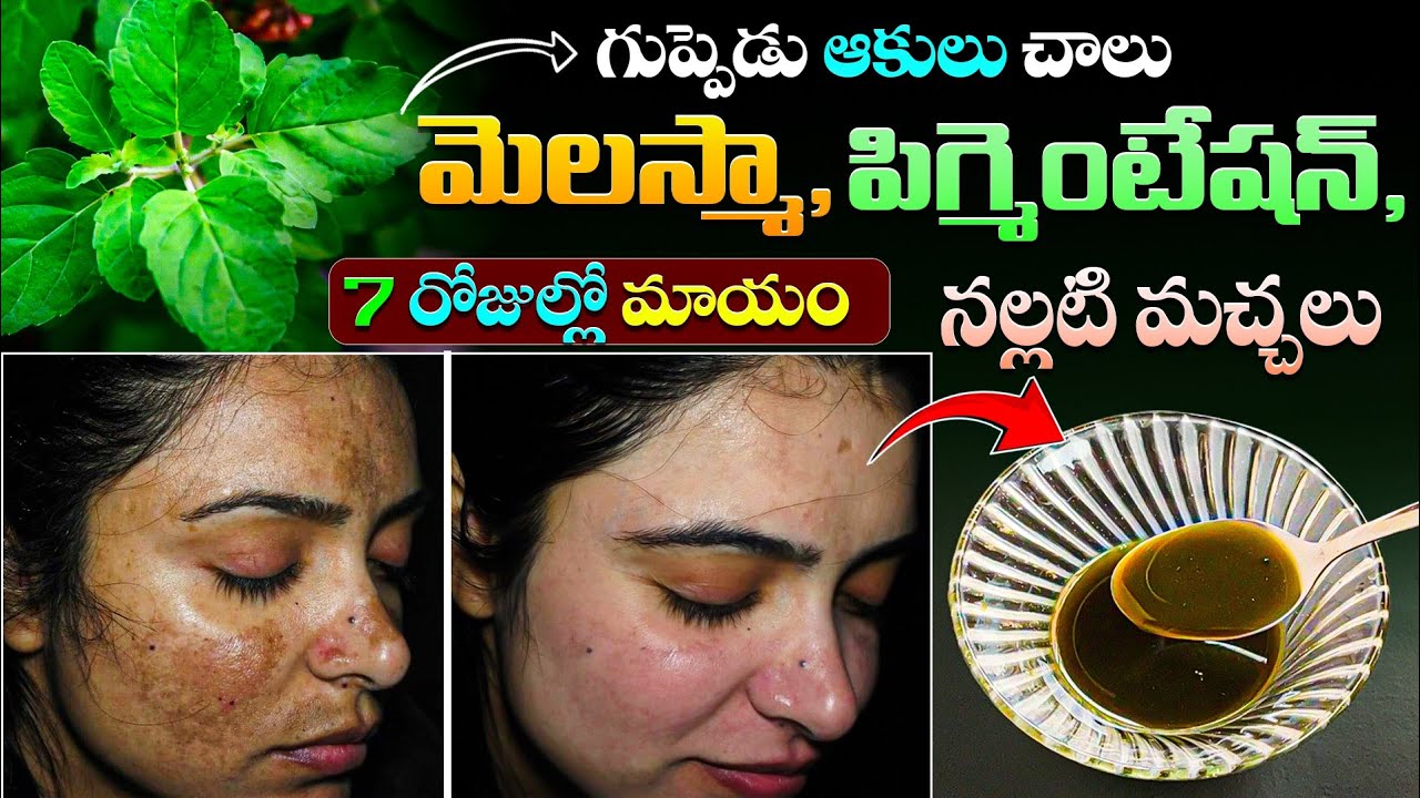 గుప్పెడు ఆకులుచాలు మెలస్మా,పిగ్మెంటేషన్,నల్లటి మచ్చలు7 రోజుల్లో మాయం | Natural Remedy For Melesma