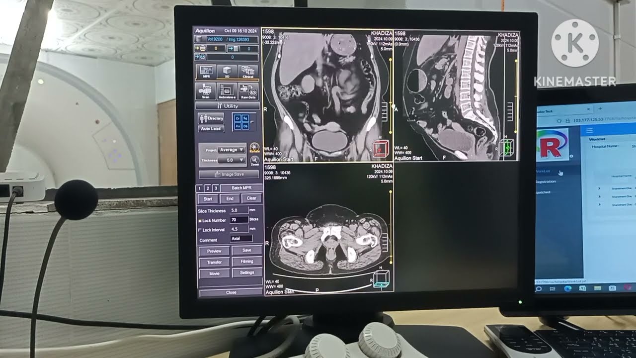 কিভাবে KUB সিটি স্ক্যান করা হয়।CT KUB non contrast/ Image making & filming process of KUB. CT KUB