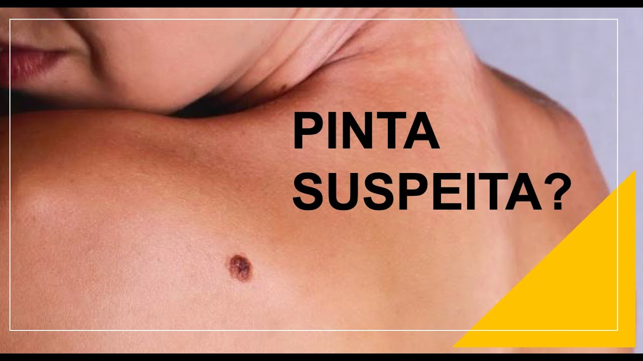 COMO SABER SE UMA PINTA &Eacute; SUSPEITA? Por Luiz Gameiro, dermatologista