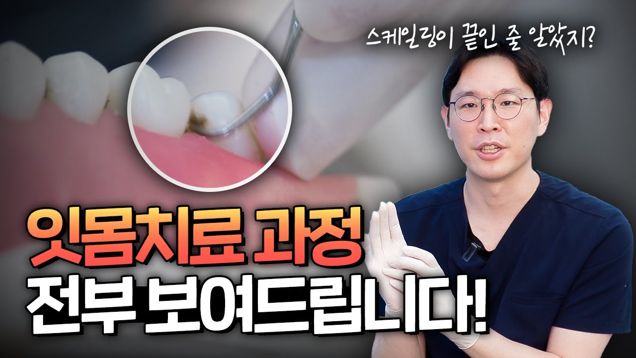 잇몸치료는 누가 받는걸까?😱⎜잇몸치료 진단방법, 치료방법 총정리, 잇몸치료 과정을 직접 보여드립니다