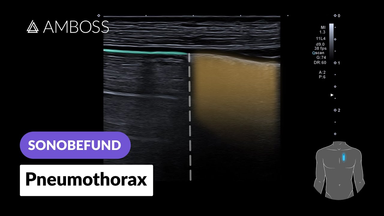 Sonobefund: Pneumothorax | AMBOSS