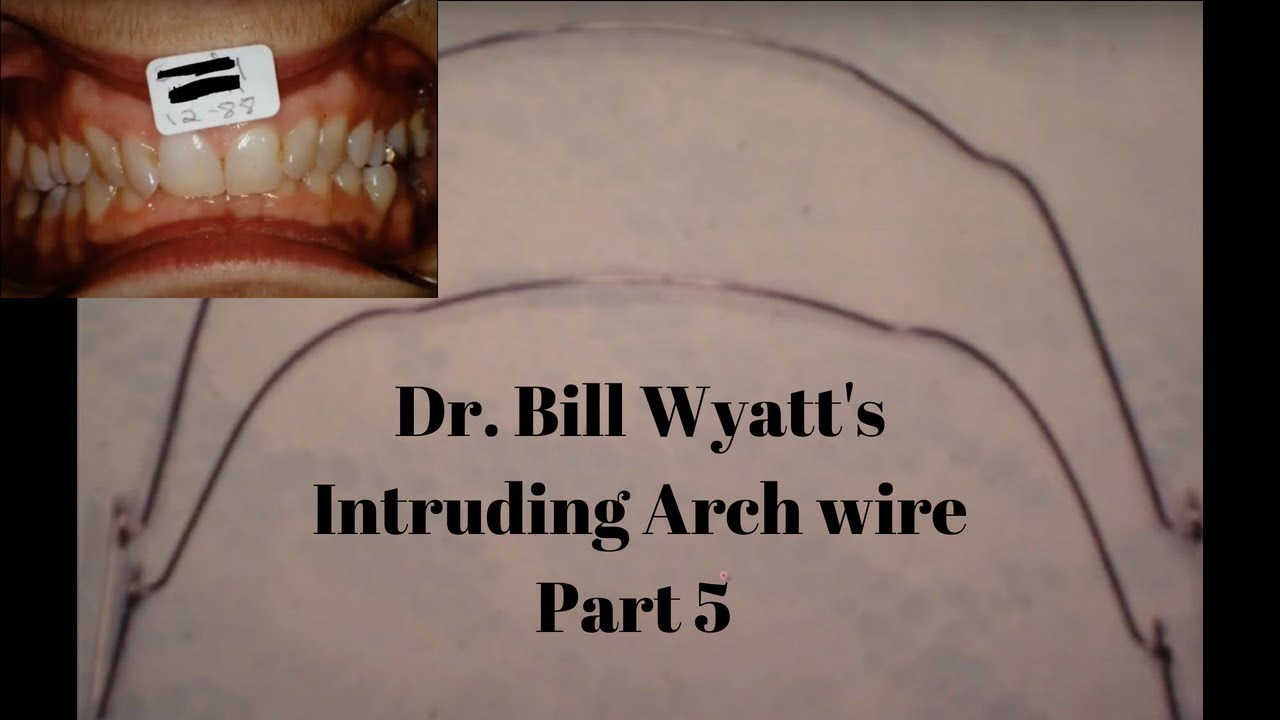 Dr.Bill Wyatt Intruding Archwire : Another Deep bite case (5 of 6)