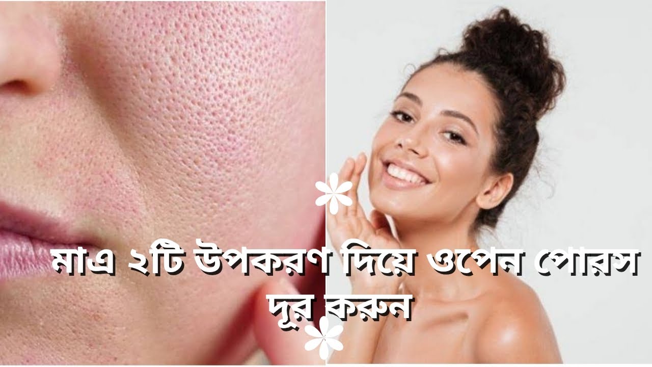 মাএ ২টি উপকরণ দিয়ে ওপেন পোরস দূর করুন।Remove open pores with these 2 ingredients.