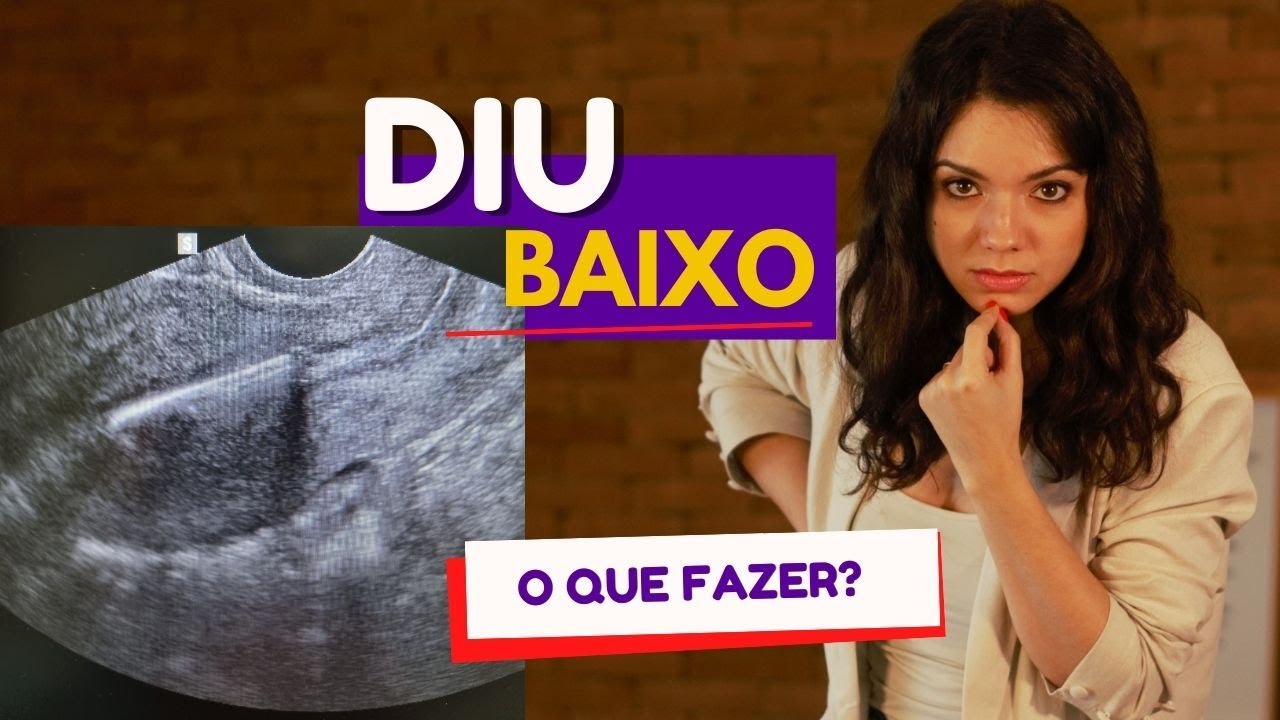 DIU BAIXO OU DIU FORA DO LUGAR: O QUE FAZER? | Mariana Viza